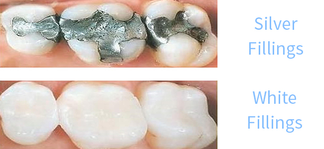 Silver’s Not your Best Option | Fresno Dentist