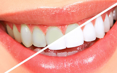Whitening For Every Smile! Get Yours | Fresno Dentist