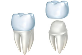 What Dental Crowns are made of?