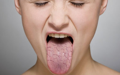 Cause, Effect, And Prevention Of Dry Mouth | Dentist Fresno CA