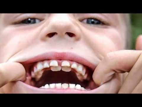 What happens if your child has two rows of teeth? | Dentist Fresno CA