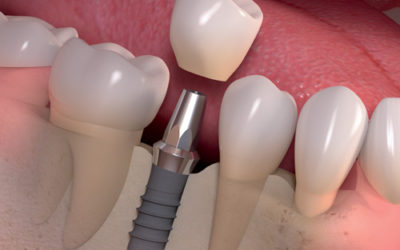 Dental Implants | Dentist Fresno