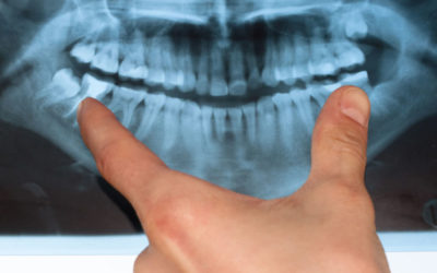Wisdom Teeth Coming In? What You Need to Know